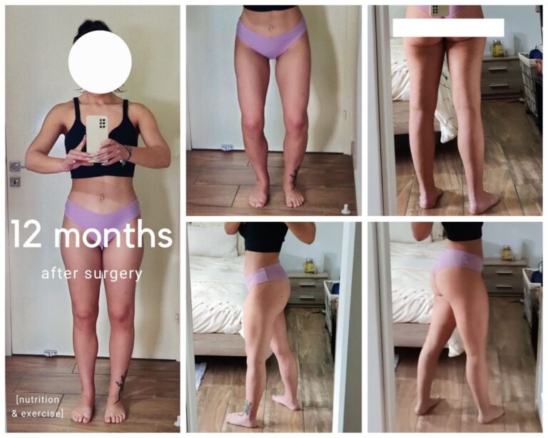 12 moths after surgery 768x614