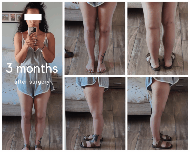 3 months after surgery min 768x614
