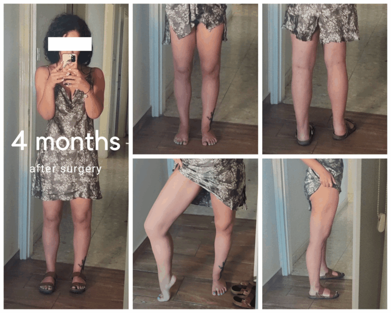 4 moths after surgery min 768x614