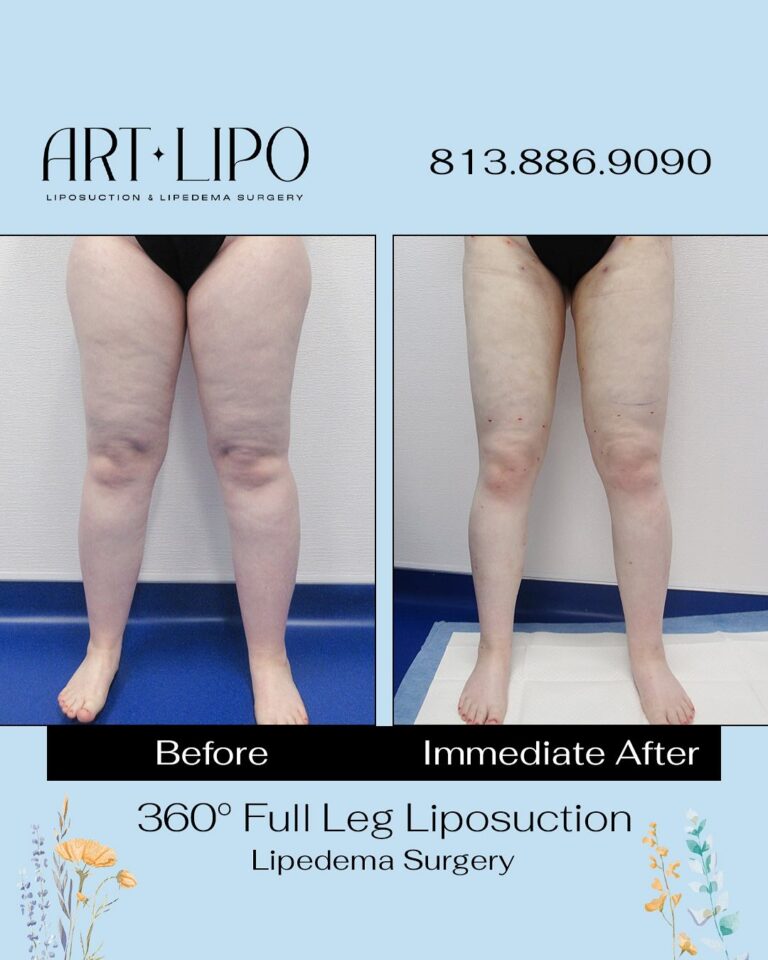 360 Full Leg lipo 1 768x960