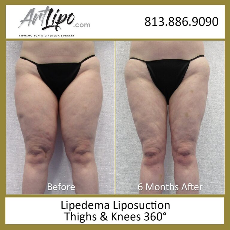 THighs Knees 1 768x768