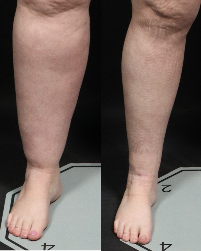 Amanda Seiger Stage 2 6 Months Post Op 768x960