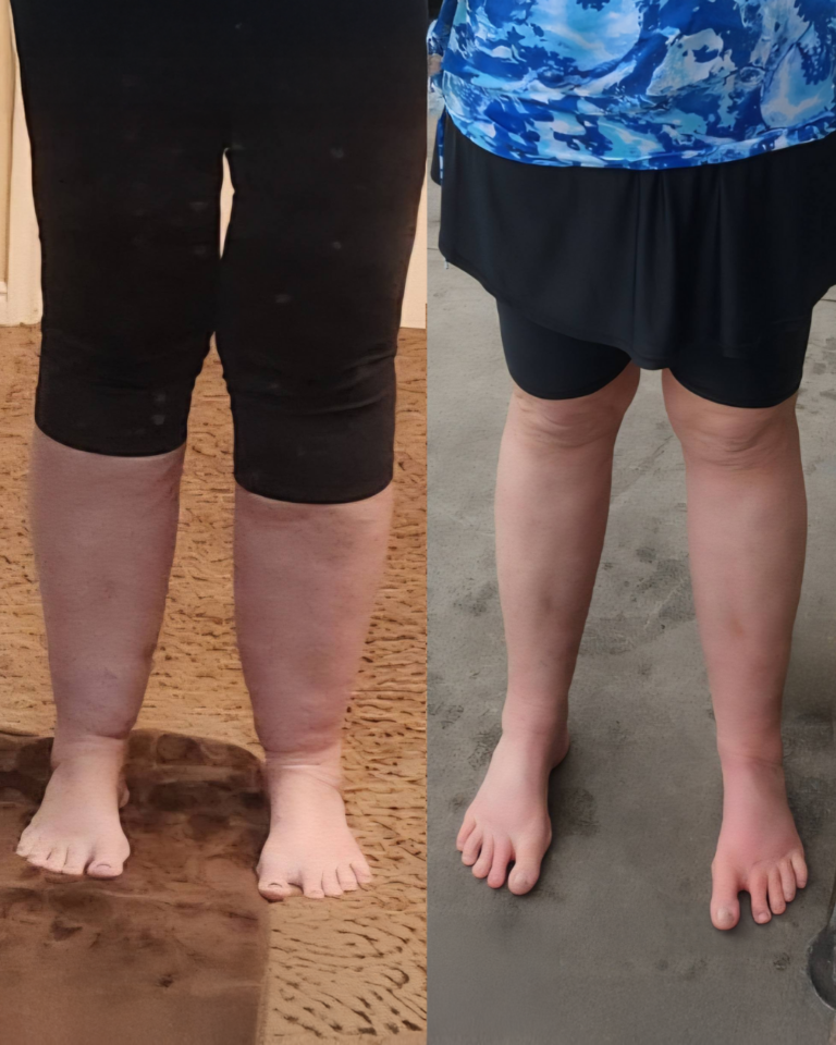 Teresa Hempel Johnson Stage 2 6 Months Post Op 768x960